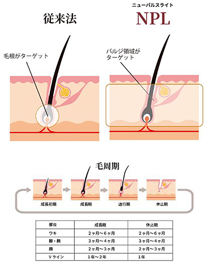 脱毛の特徴02